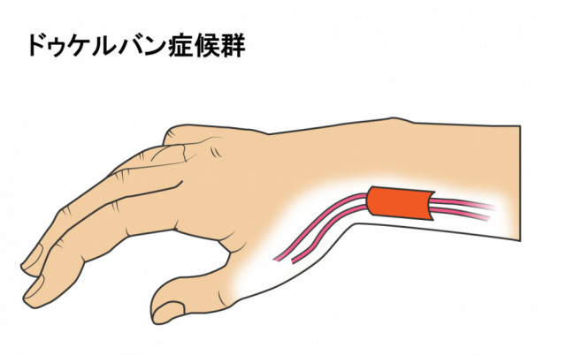 手の腱のイラスト